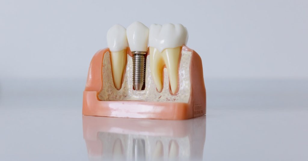 The Benefits And Drawbacks of Dental Implants