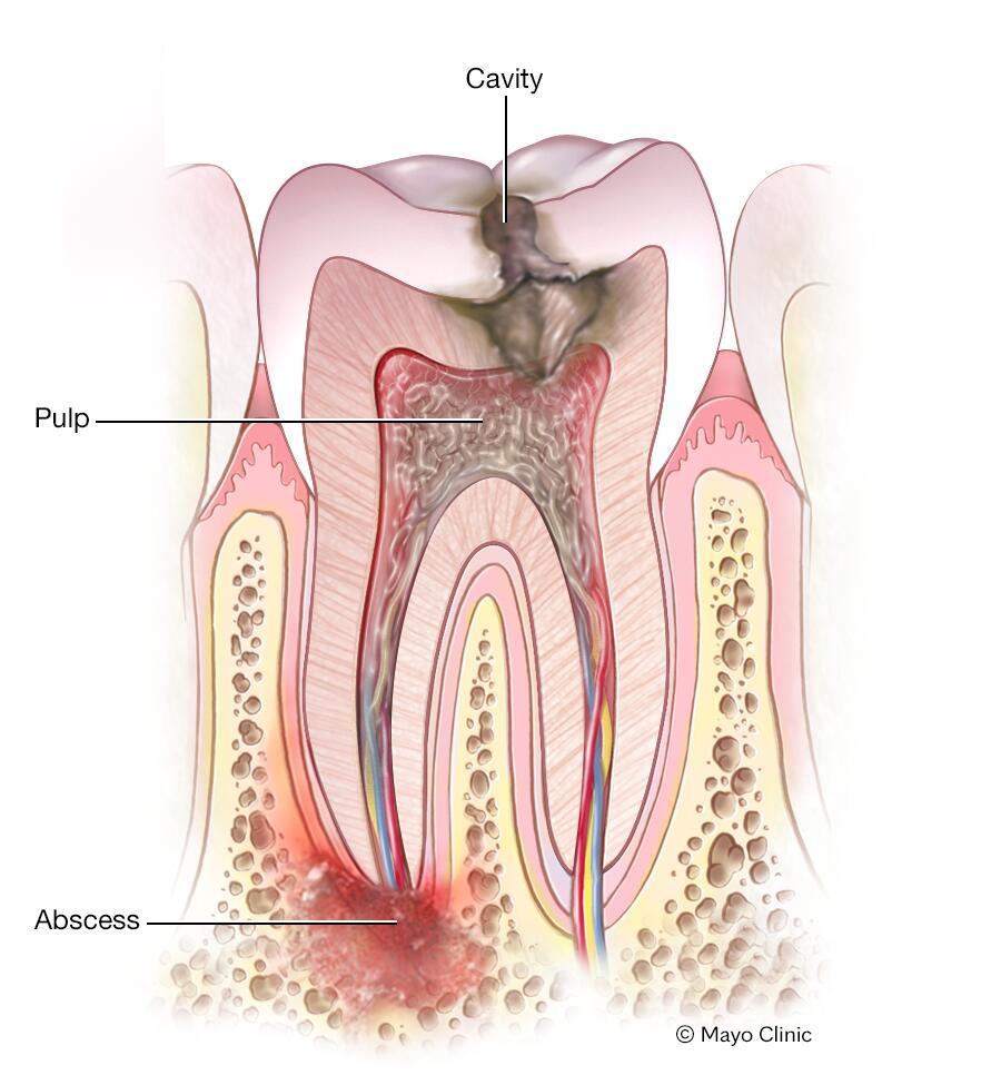 Abscessed Tooth Treatment