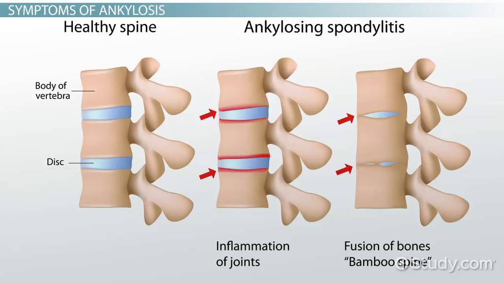 Ankylosis