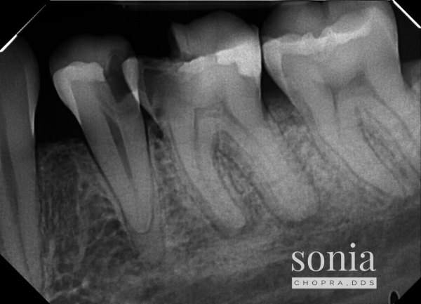 Apical Lesion