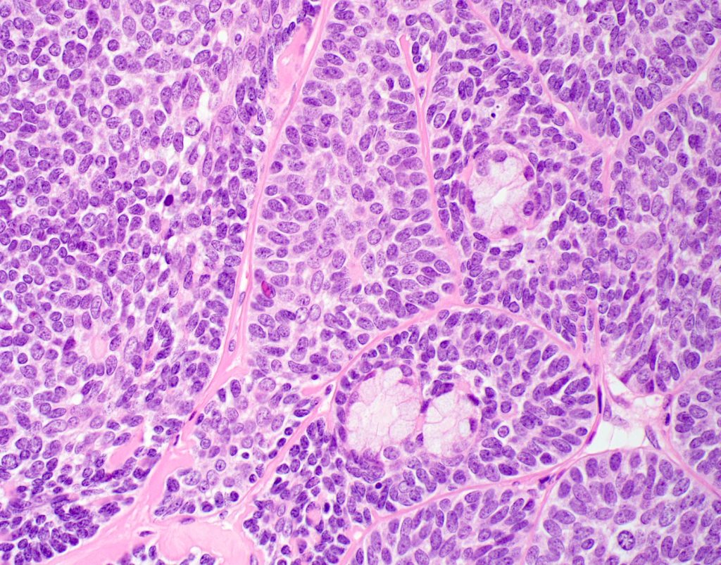 Basal Cell Carcinoma of Salivary Gland