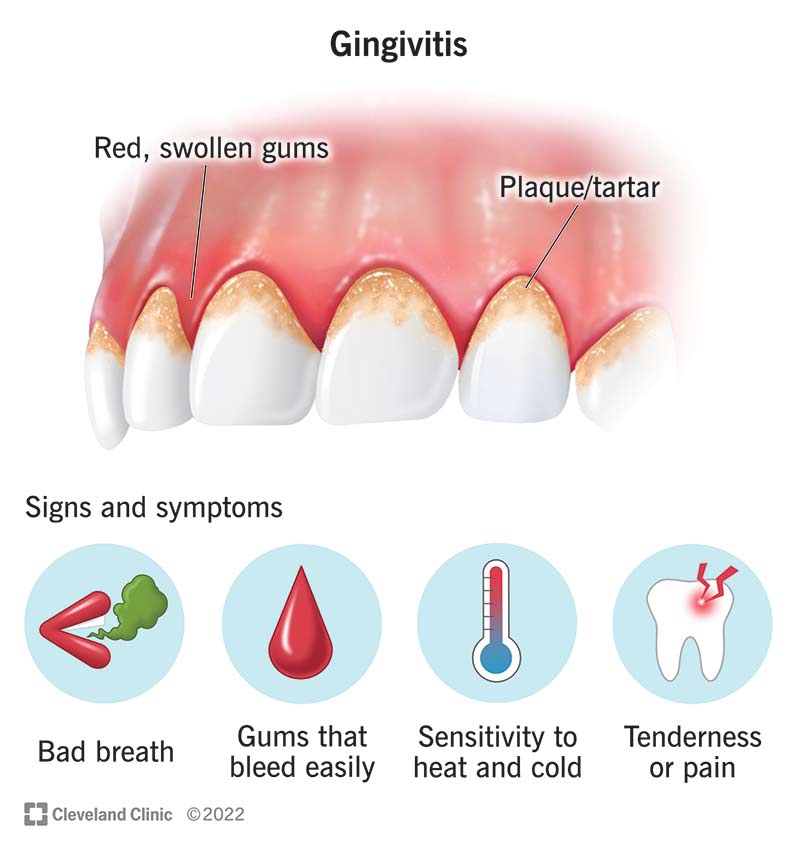 Bleeding Gums Treatment