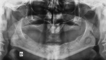 Cement Ossifying Fibroma