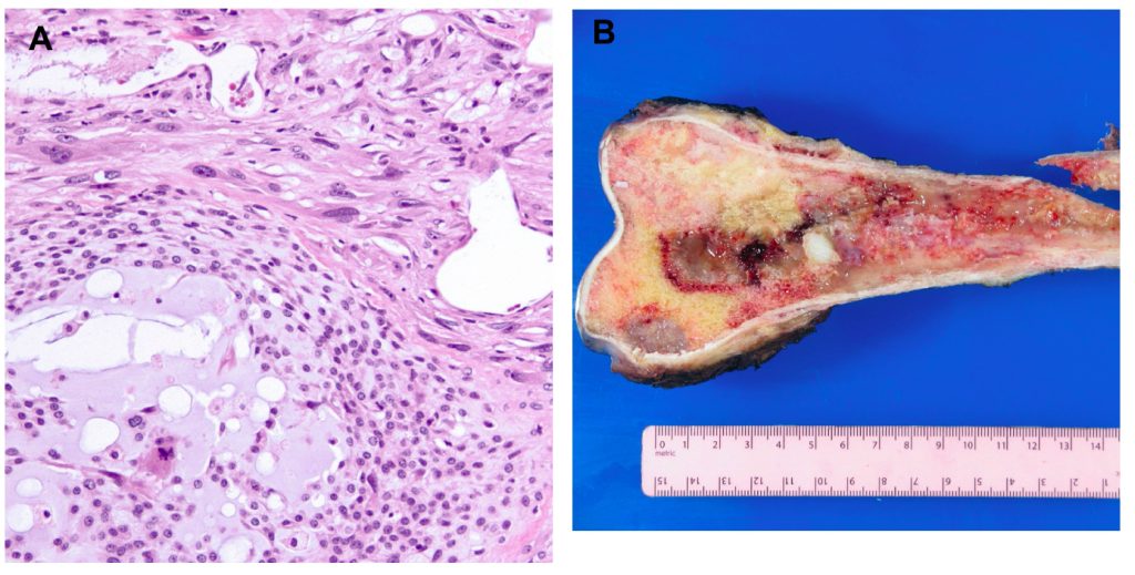 Chondrosarcoma