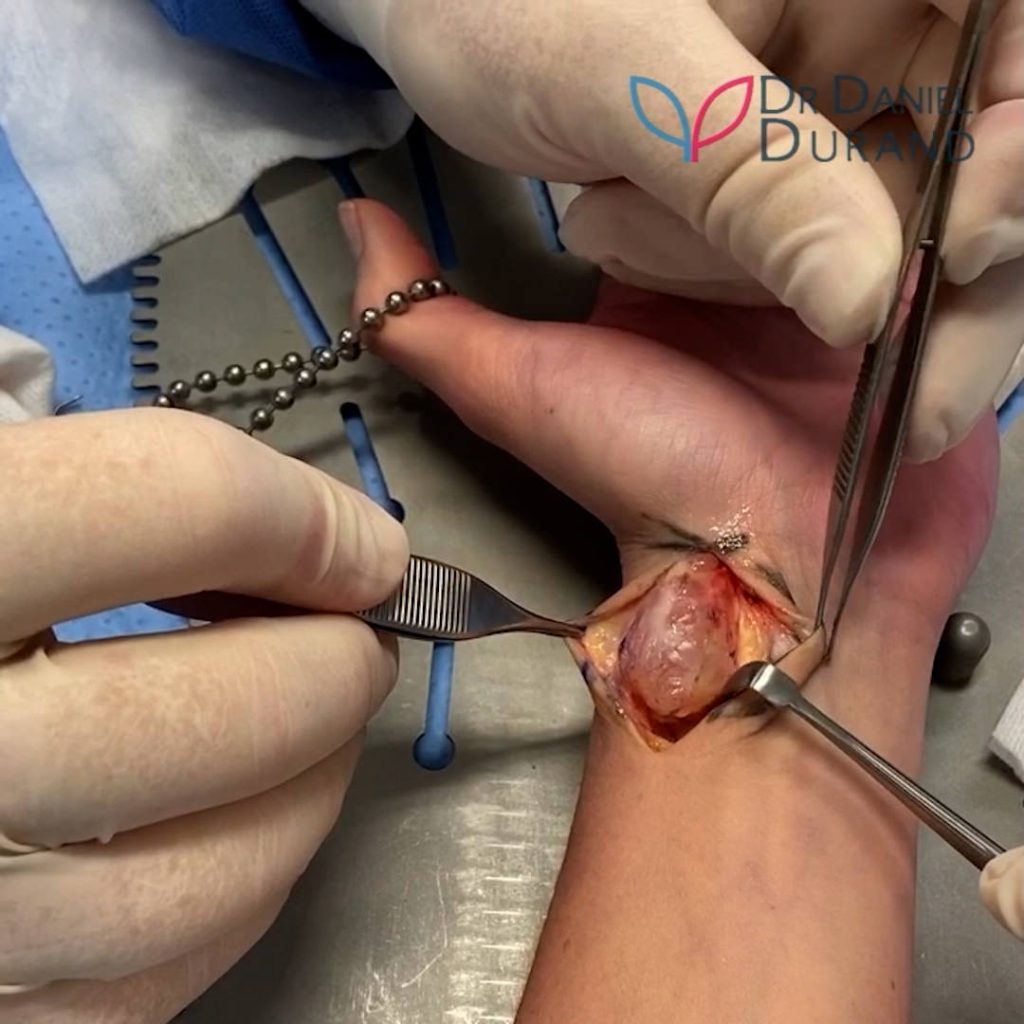 Cyst