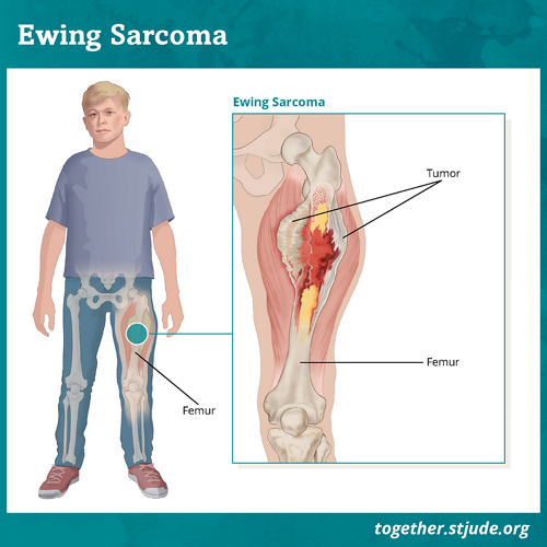 Ewings Sarcoma