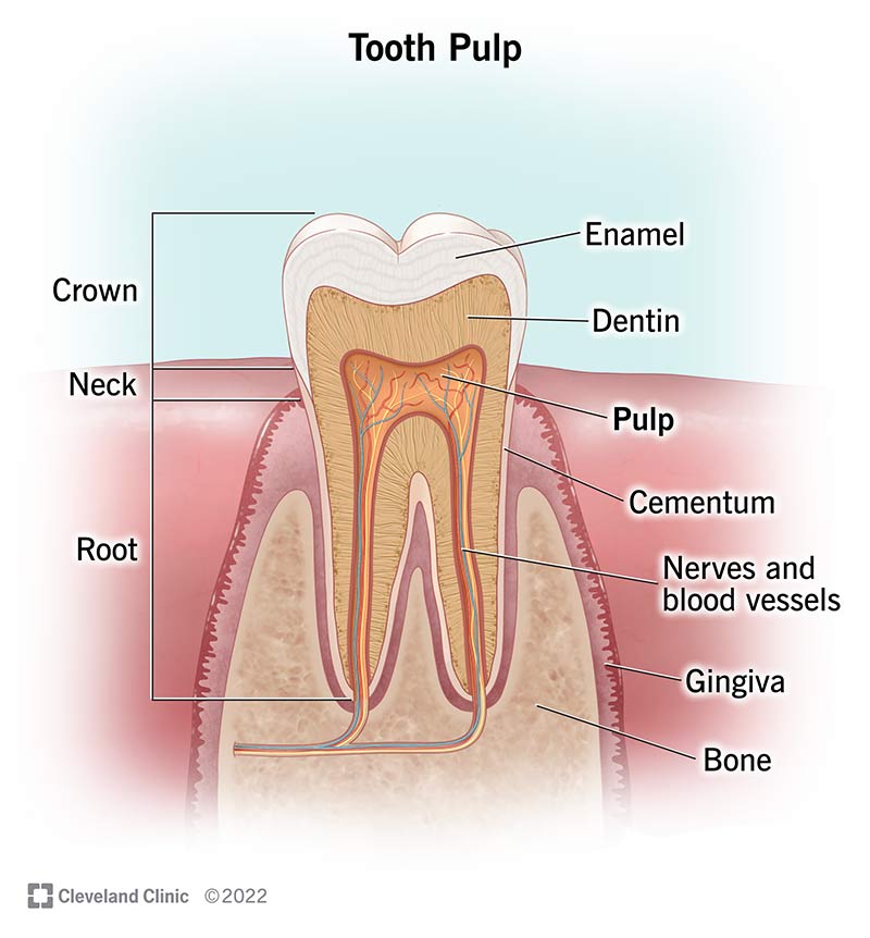 Exposed Pulp Tooth