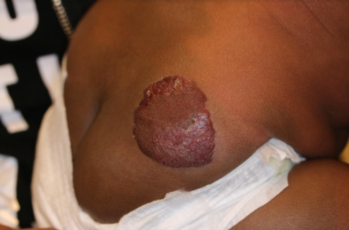 Hemangioma