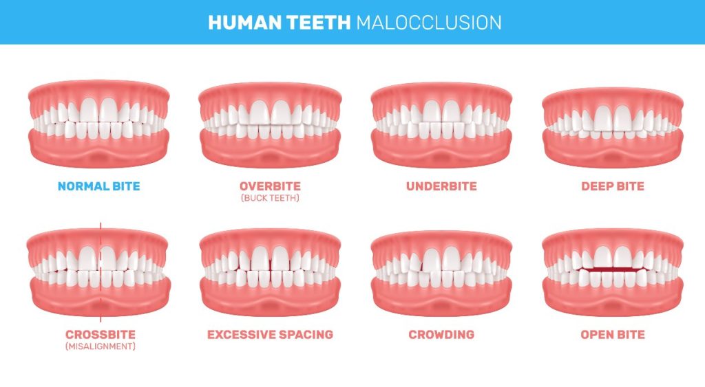 Malocclusion