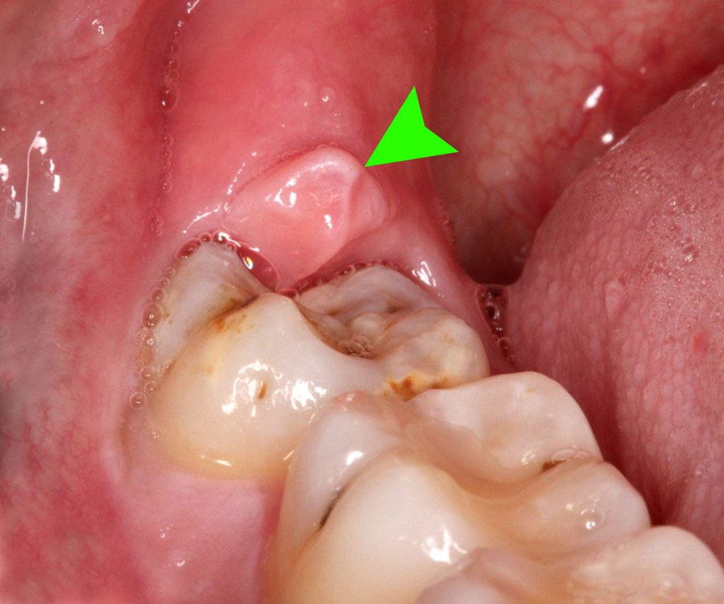 Pericoronitis