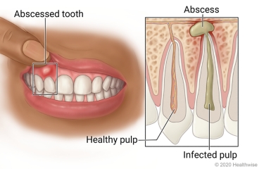 Periodontal Abcess