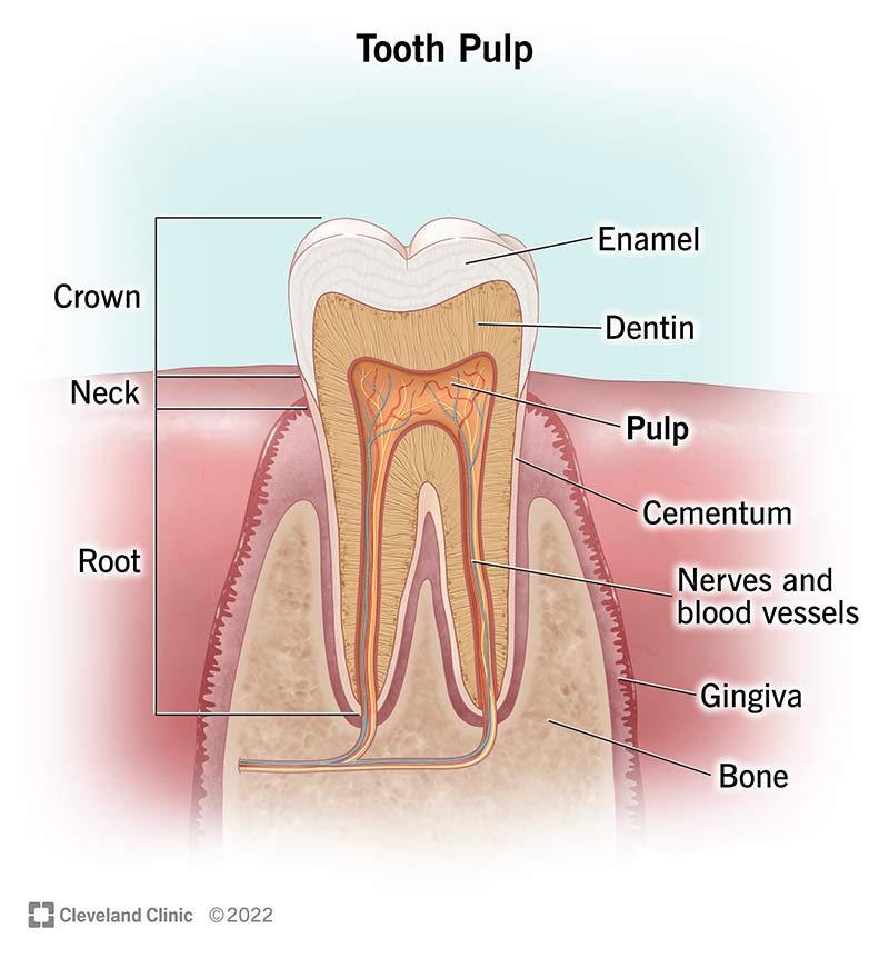 Pulp Exposure Tooth