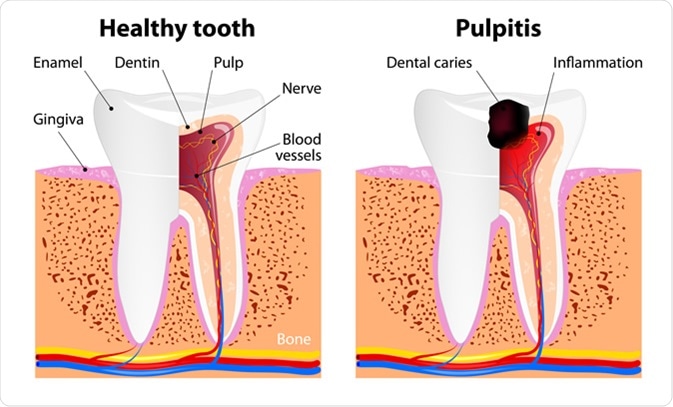 Pulpitis