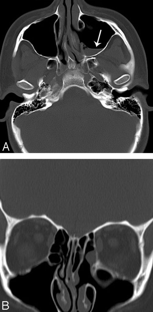 Retention Cyst