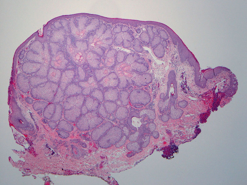 Sebaceous Adenoma