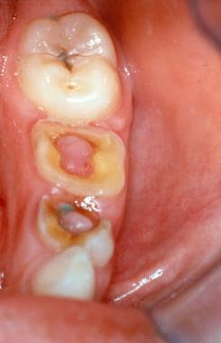 Treatment of Pulp Polyp