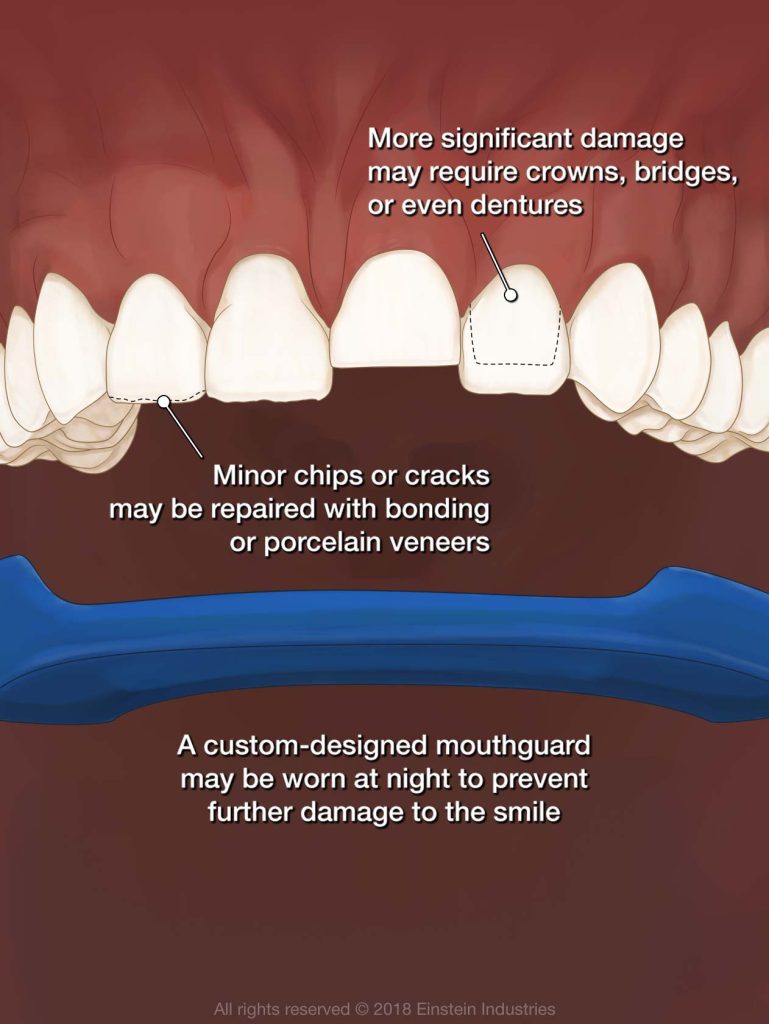 What is Bruxism And How to Treatment It