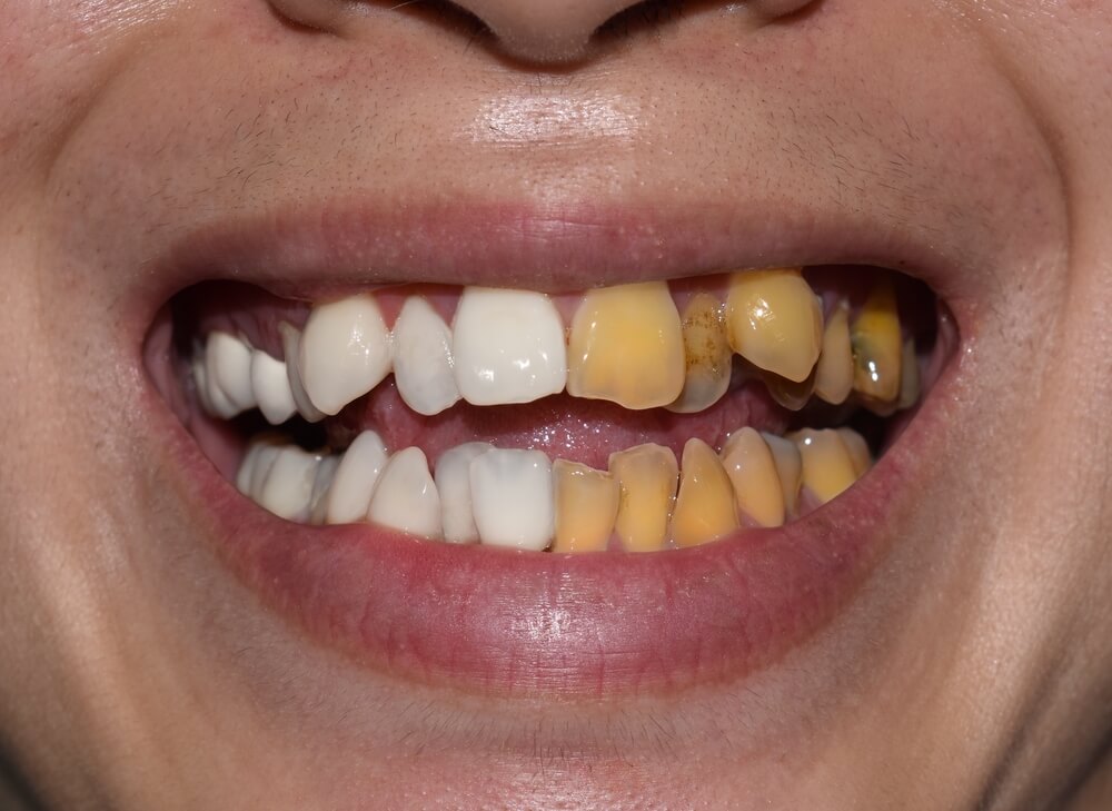 Yellow Teeth Causes And Treatment